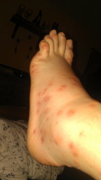 And I got bitten like this that night (July 2013) And I got bitten like this that night (July 2013)